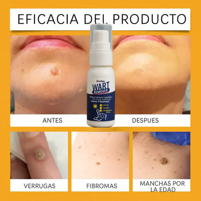 🤩Crema Removedora de Verrugas y Lunares Wart Remover | Elimina con suavidad y rapidez