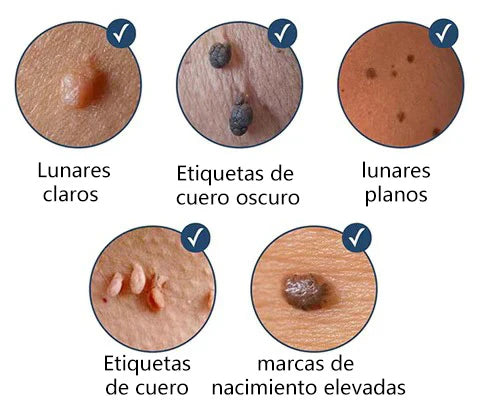 🤩Crema Removedora de Verrugas y Lunares Wart Remover | Elimina con suavidad y rapidez